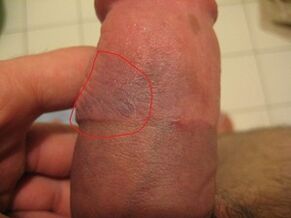 bruising on the penis due to improper use of the pump